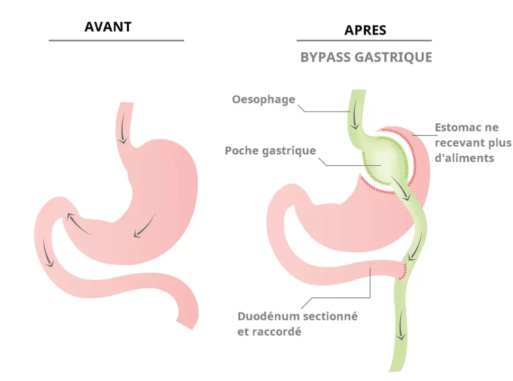 Solution contre l’obésité : le bypass gastrique