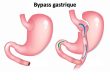 Bypass gastrique: nouvelle vie et santé le saut