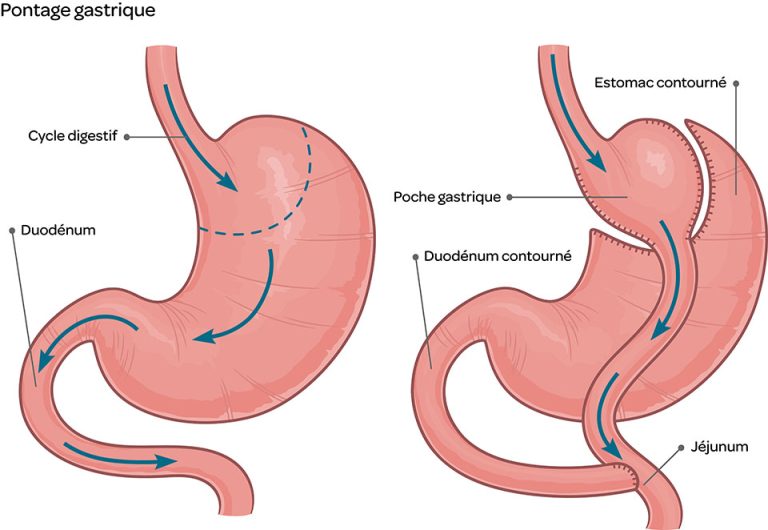 Bypass gastrique – comment ça marche et pour qui est-il indiqué?