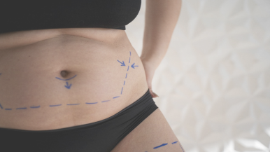 Liposuccion et Chirurgie Bariatrique : Objectifs et Indications Distincts