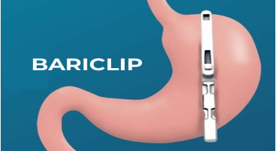 Bariclip: futur de la chirurgie bariatrique ?