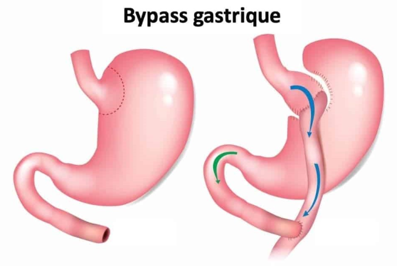 L’obésité a une solution: le bypass gastrique